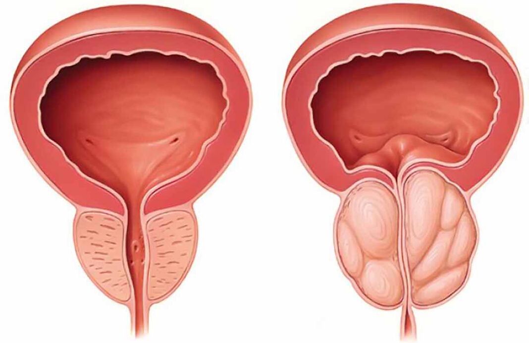 Normalna prostata in vnetje prostate (kronični prostatitis)