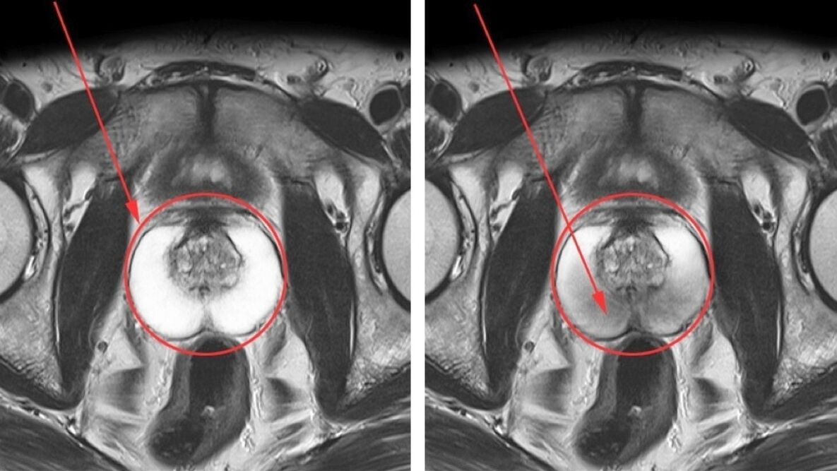 Ultrazvok za kronični prostatitis – zdrava prostata (levo) in vneta (desno)