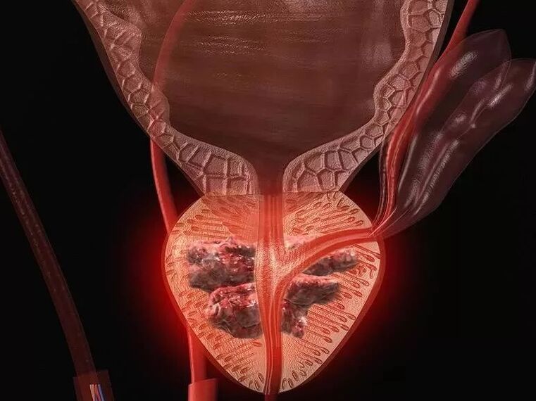Prostatitis pri moških