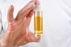 Analiza urina je ena od metod za diagnosticiranje prostatitisa
