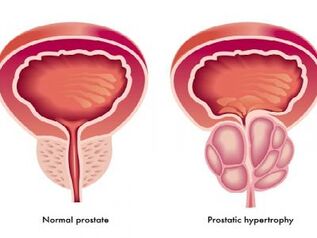 Normalna in vneta prostata