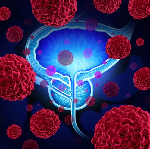 Dejavnost patogenih mikroorganizmov je vzrok za razvoj prostatitisa