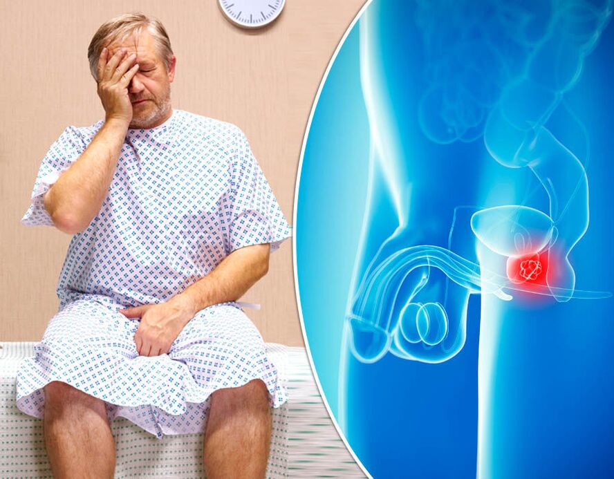 Moški s prostatitisom je podvržen diagnozi bolezni