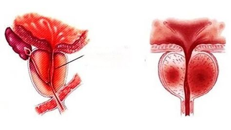 Kako izgleda kronični prostatitis